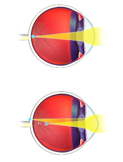 Astigmatism