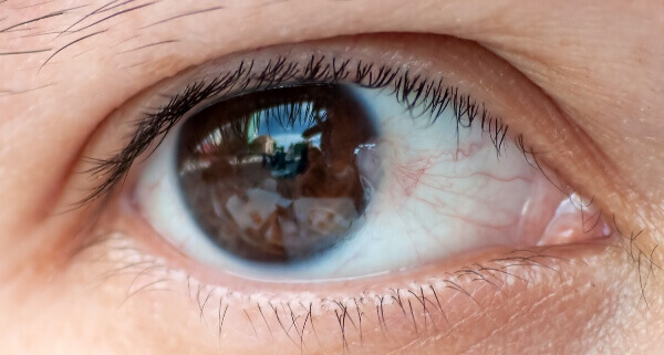 Pterygium conjunctiva
